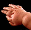 Polydactyly