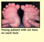 Polydatyly of Toes